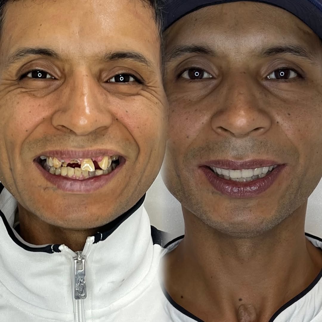 Transformação de Sorriso 13
